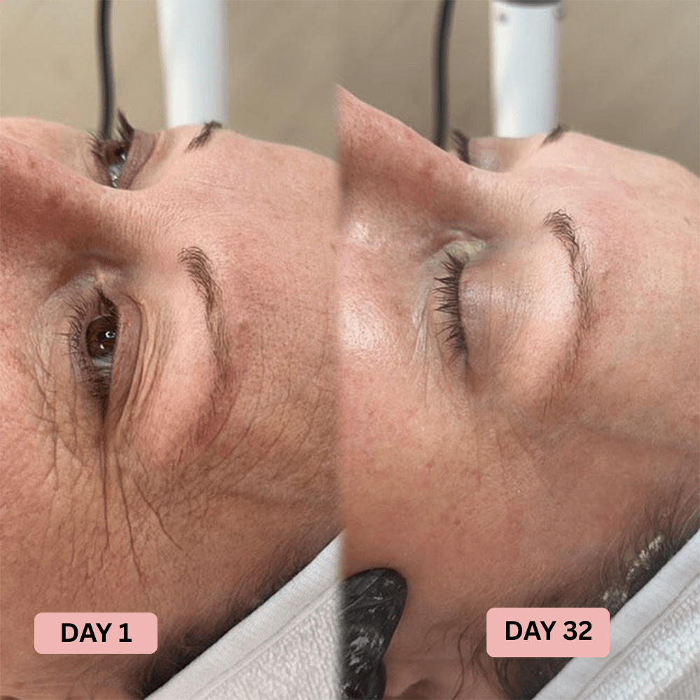 Visibly Firmer, Smoother Skin in 14 Days - Without Injectables - Lumier Noir